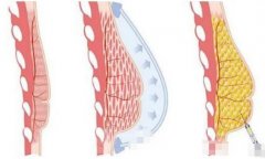注射隆胸的優(yōu)勢(shì)：這就是有些人胸大的秘密