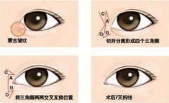 開眼角手術果不理想，解決方法在這里！