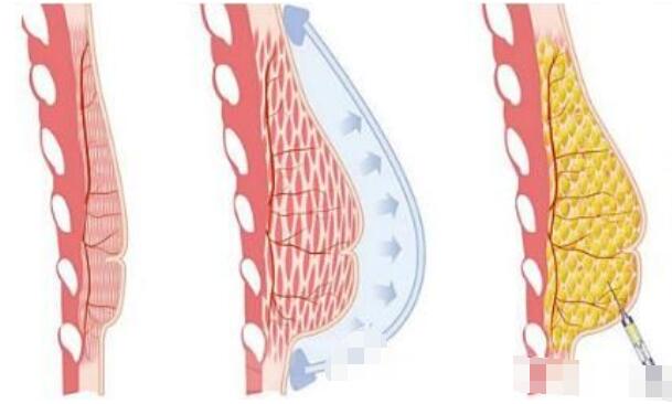 隆胸手術(shù)的原理