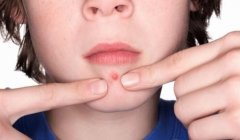 下巴長(zhǎng)痘反反復(fù)復(fù)？分析一下可能是這4種原因！