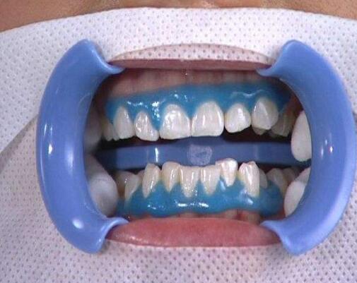 冷光美白能讓吸煙人牙齒變白嗎？