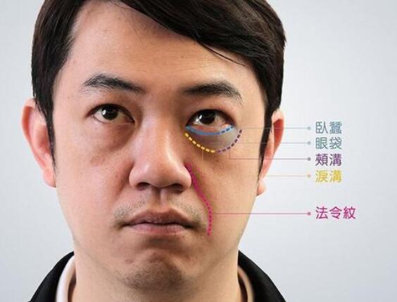 眼袋的四種類型