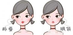 了解到臥蠶、淚溝、眼袋的區(qū)別，你就知道去除的方法了！