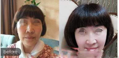 遼陽知鑫醫(yī)療美容門診部面部除皺案例