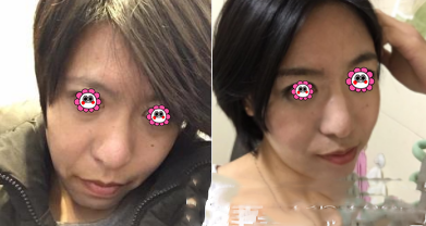 北京和諧美麗匯醫(yī)療美容半紋眉案例