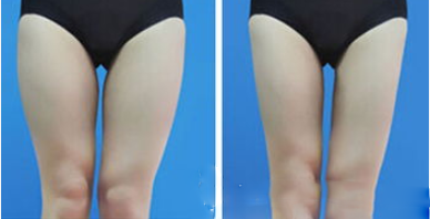 北京和諧美麗匯醫(yī)療美容腿部吸脂案例