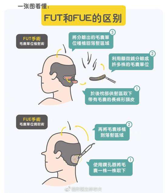 【盤點】FUT有痕頭發(fā)種植和FUE微創(chuàng)植發(fā)技術(shù)哪里截然不同？