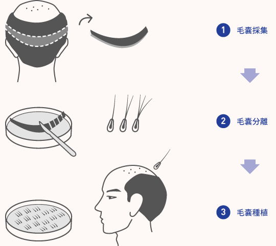 【盤點】FUT有痕頭發(fā)種植和FUE微創(chuàng)植發(fā)技術(shù)哪里截然不同？