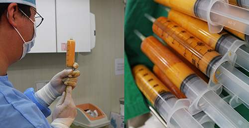 做完脂肪填充面部后擔(dān)心終成豬頭？消腫小妙招~