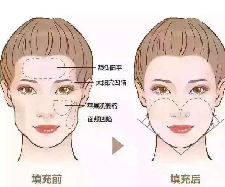 做完脂肪填充面部后擔(dān)心終成豬頭？消腫小妙招~