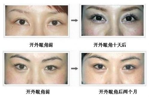 開眼角手術(shù)能給你們帶來什么作用？不單單是放大眼睛哦~