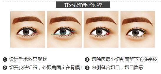開眼角手術(shù)能給你們帶來什么作用？不單單是放大眼睛哦~