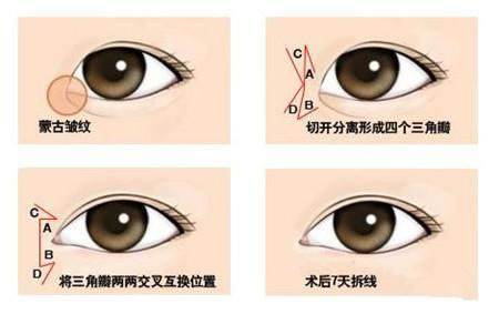 開眼角手術(shù)能給你們帶來什么作用？不單單是放大眼睛哦~