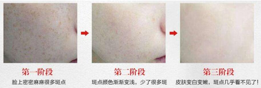 黃褐斑調(diào)節(jié)