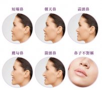 朝天鼻靠捏鼻子就能改良？朝天鼻整容手術(shù)了解一下吧！