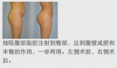 自體脂肪豐臀和假體豐臀的優(yōu)點(diǎn)和缺點(diǎn)，以便于更好的選擇