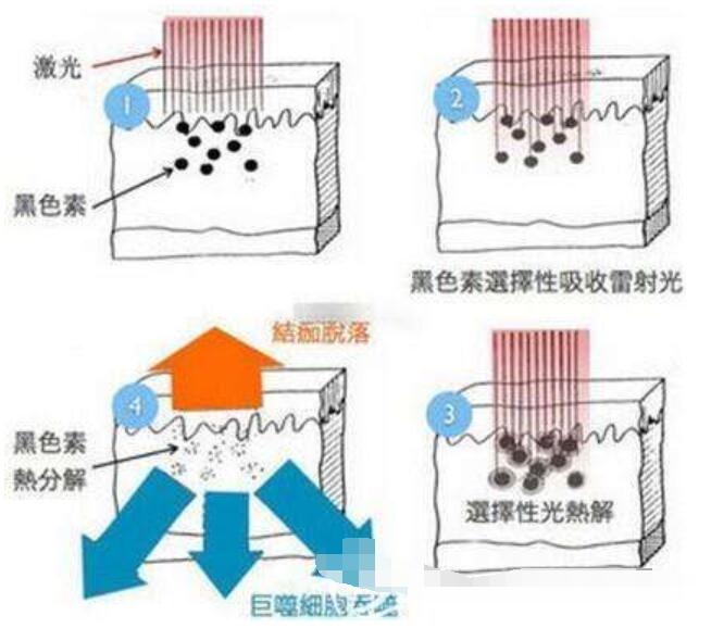 激光祛斑原理圖