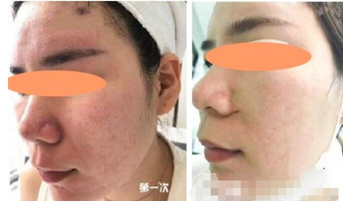 5次點(diǎn)陣激光祛痘坑果圖