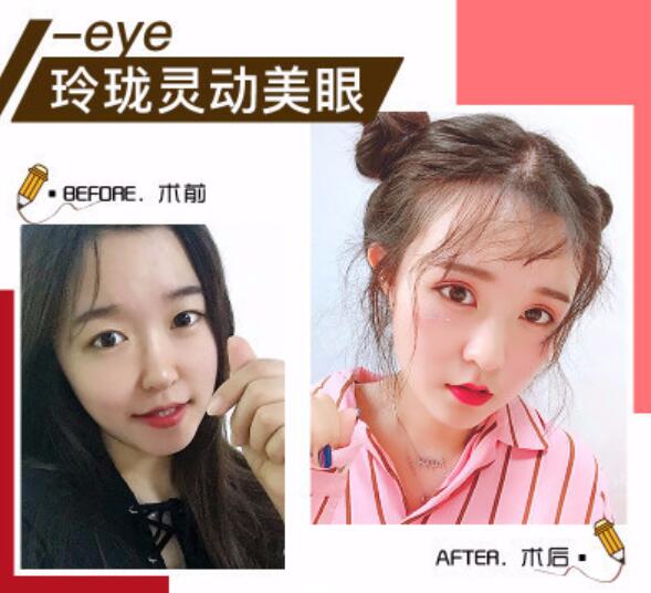 北京協(xié)和醫(yī)院雙眼皮案例