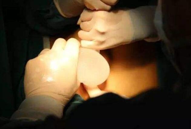 上海九院隆胸整形手術