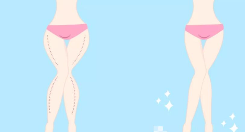 大腿吸脂手術(shù)