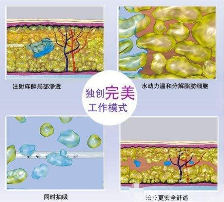 水動力吸脂和傳統(tǒng)吸脂術(shù)對比