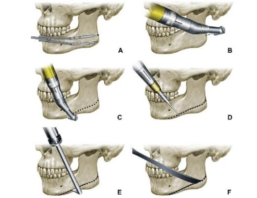 2年前做完下頜骨截骨手術，現如今來給大伙兒科學普及一下下！