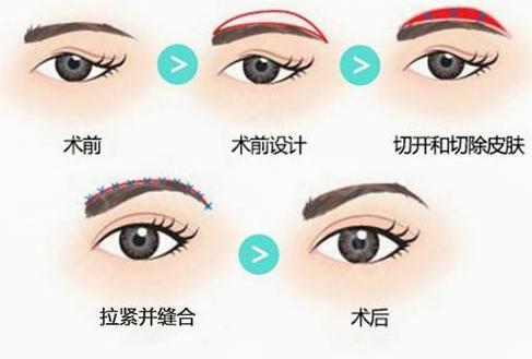 提眉手術(shù)前術(shù)后對(duì)比圖片，提眉手術(shù)和提眉手術(shù)的不同之處~