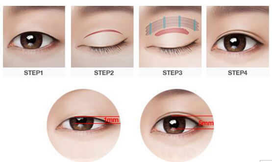 眼睛整形需要多少錢(qián)？眼部整容手術(shù)竟然還涉及這么多種！