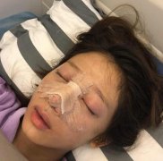 終于知道了駝峰鼻矯正價(jià)格，術(shù)后來分享一下