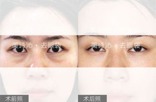 美詩沁去眼袋技術(shù)水平分析，不開刀也可以去眼袋~