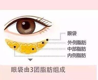 微創(chuàng)祛眼袋需要多少錢？它的基本原理和操作流程
