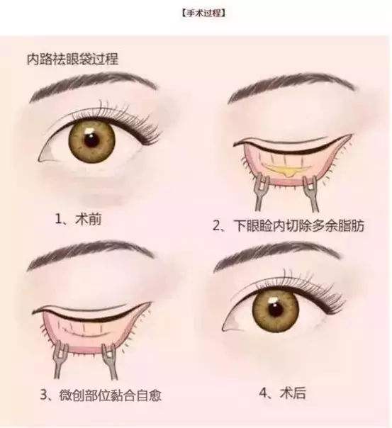 微創(chuàng)祛眼袋需要多少錢？它的基本原理和操作流程