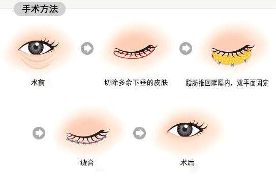 內(nèi)路去眼袋多長(zhǎng)時(shí)間能恢復(fù)正常？會(huì)有并發(fā)癥嗎？