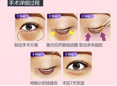 內(nèi)路去眼袋多長(zhǎng)時(shí)間能恢復(fù)正常？會(huì)有并發(fā)癥嗎？