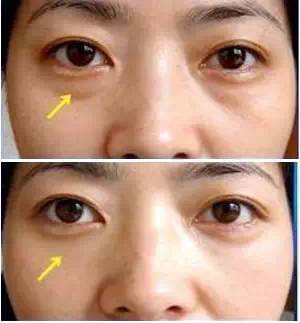 內(nèi)路去眼袋多長(zhǎng)時(shí)間能恢復(fù)正常？會(huì)有并發(fā)癥嗎？