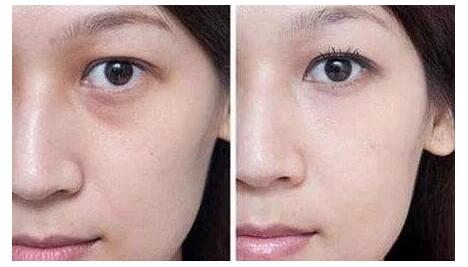 去黑眼圈手術(shù)需要多少錢？手術(shù)要做幾次？