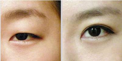 做雙眼皮需要多少錢(qián)？選擇一個(gè)知名度高的的醫(yī)師價(jià)錢(qián)貴嗎？