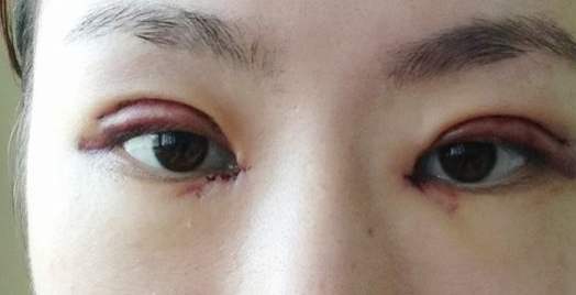 做完全切后感染了怎么辦？補(bǔ)救小妙招