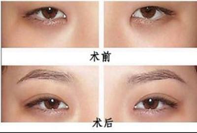 做了雙眼皮手術(shù)后還能做近視眼矯正術(shù)嗎？當(dāng)然可以啦
