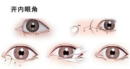 韓式開眼角整容手術(shù)術(shù)后康復(fù)時間及注意事項