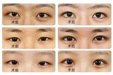 韓式開眼角整容手術(shù)術(shù)后康復(fù)時間及注意事項