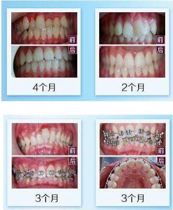 上海九院牙齒矯正案例
