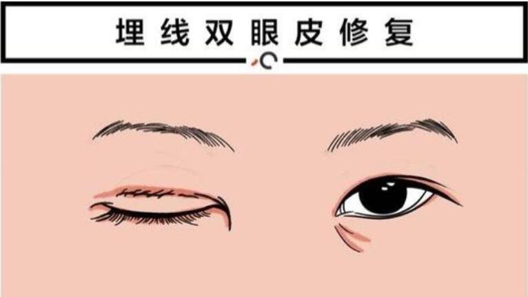 埋線雙眼皮失敗修復(fù)