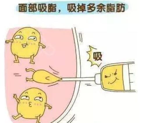 面部吸脂手術(shù)恢復(fù)期