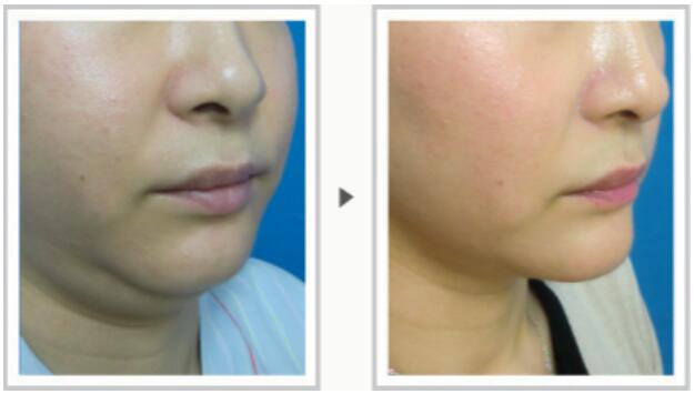 面部吸脂手術(shù)果圖