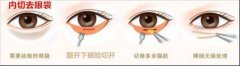內(nèi)切祛眼袋比較適合哪些人做？手術(shù)要拆線嗎？