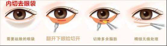 內(nèi)切祛眼袋比較適合哪些人做？手術(shù)要拆線嗎？