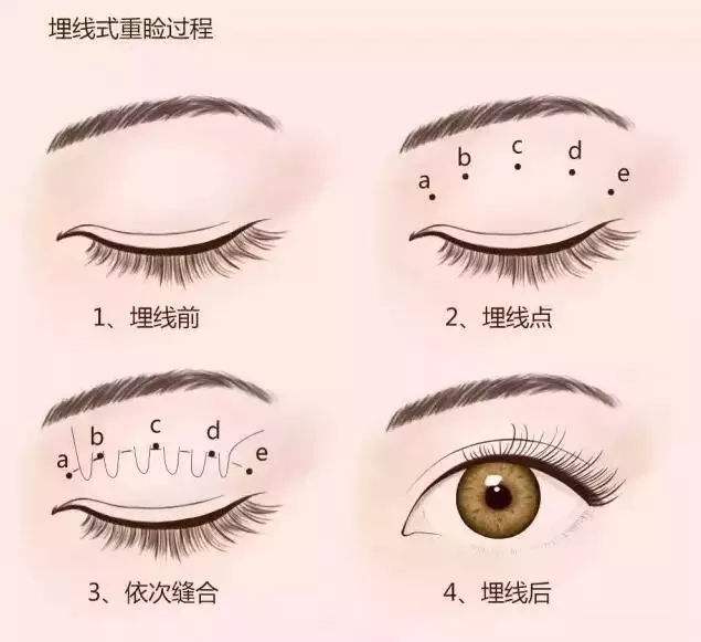 哪些人適合做全切雙眼皮？哪些人不必做全切，埋線也可以