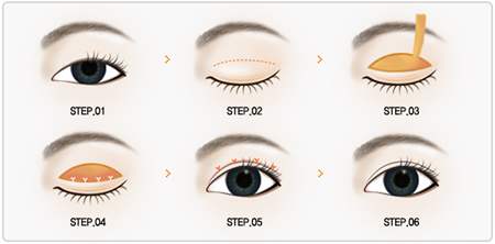 哪些人適合做全切雙眼皮？哪些人不必做全切，埋線也可以